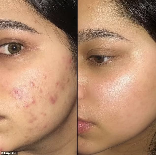 Acne & Pimple Control Facial Soap