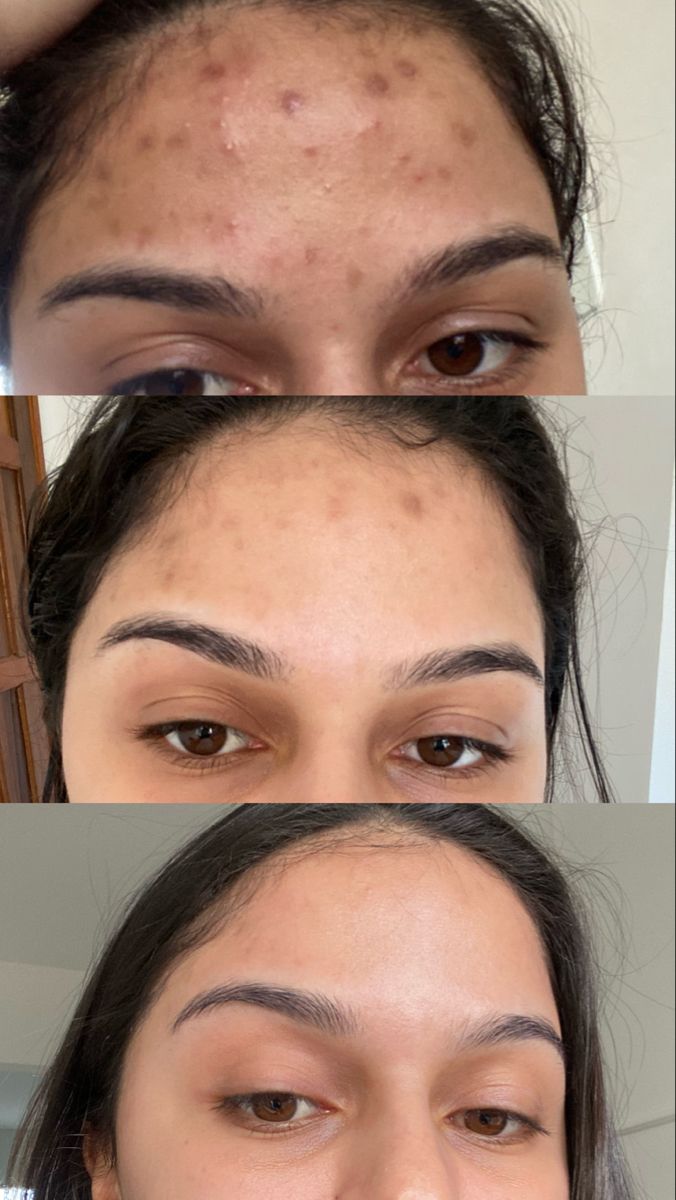 Acne & Pimple Control Facial Soap